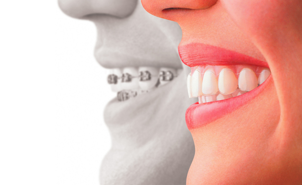invisalign